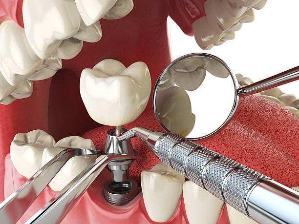 Best Emergency Root Canal Treatment in Cottonwood, ID